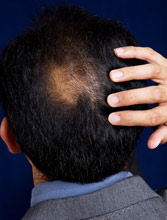 hair loss treatment laser comb
